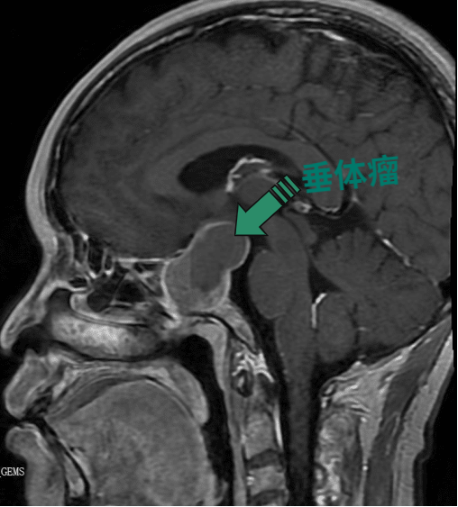 视力减退要当心！小心是垂体腺瘤哦
