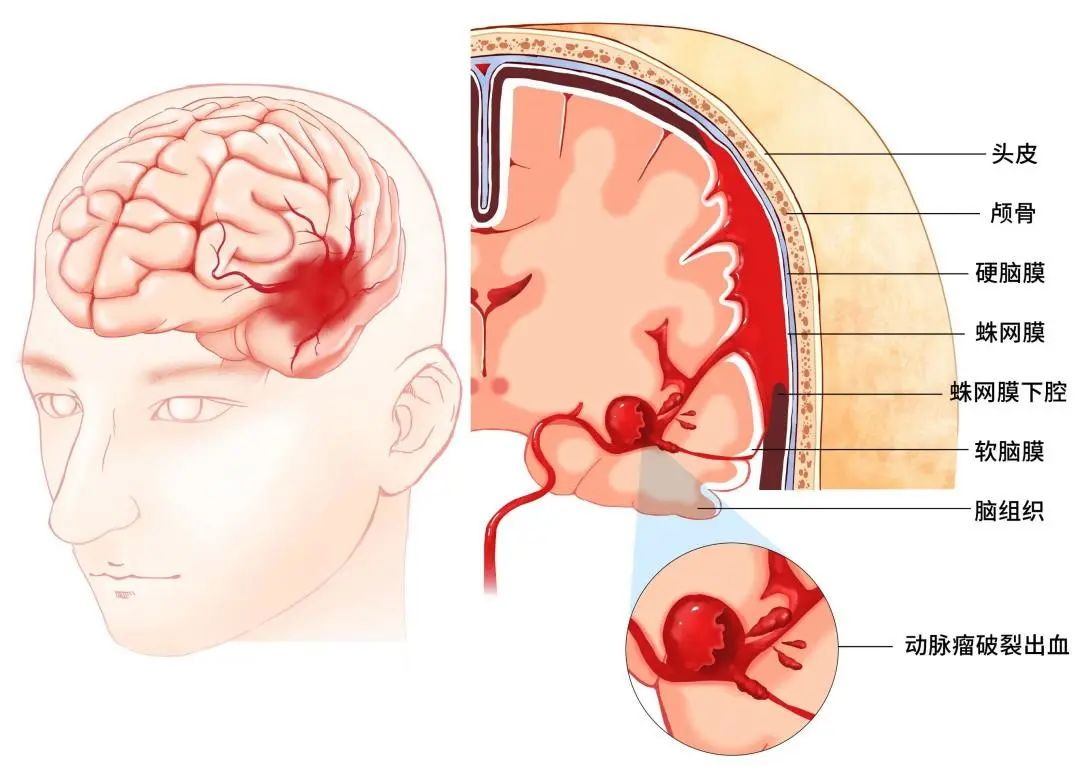 脑健康系列科普一 | 脑动脉瘤，不是肿瘤却比肿瘤更凶险