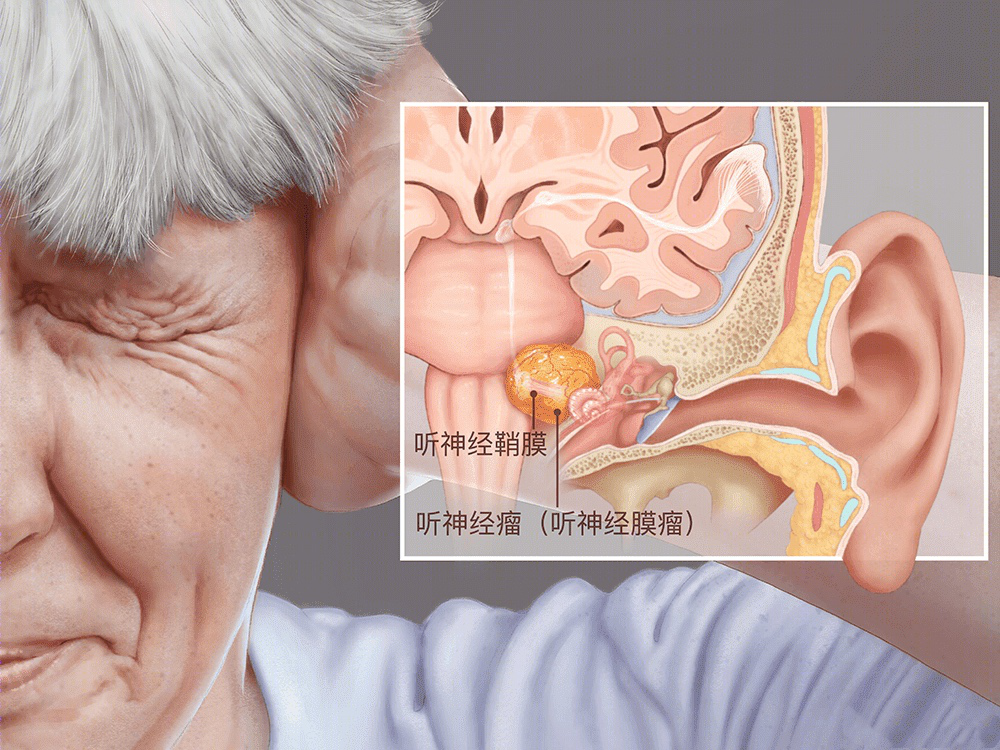 头晕耳鸣，听力下降？ 别不当一回事，可能是这种肿瘤导致！