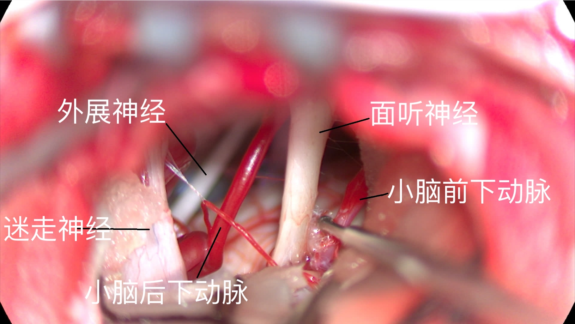 华安脑科医院成功开展首例面肌痉挛显微血管减压术 华安脑科医院成功开展首例面肌痉挛显微血管减压术