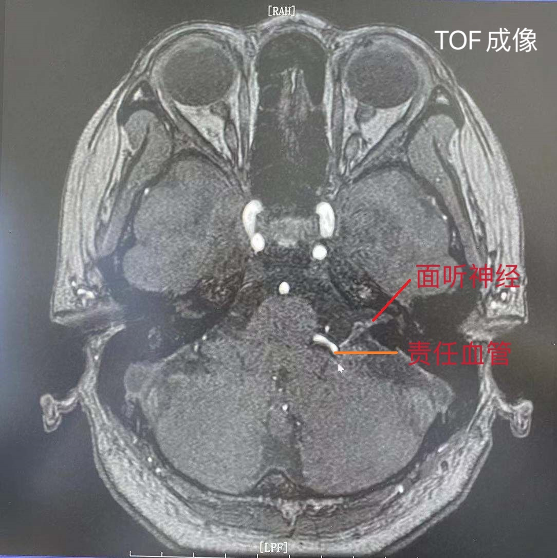 华安脑科医院成功开展首例面肌痉挛显微血管减压术 华安脑科医院成功开展首例面肌痉挛显微血管减压术